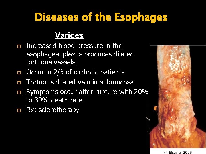 Diseases of the Esophages Varices Increased blood pressure in the esophageal plexus produces dilated