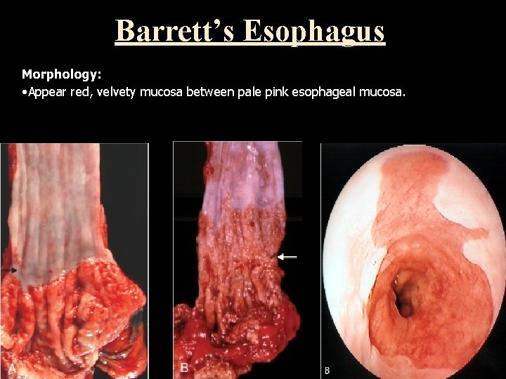 Barrett’s Esophagus Morphology: • Appear red, velvety mucosa between pale pink esophageal mucosa. 