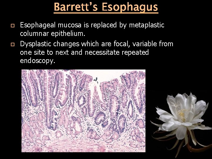 Barrett’s Esophagus Esophageal mucosa is replaced by metaplastic columnar epithelium. Dysplastic changes which are