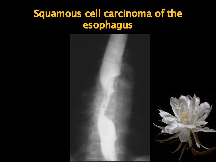 Squamous cell carcinoma of the esophagus 