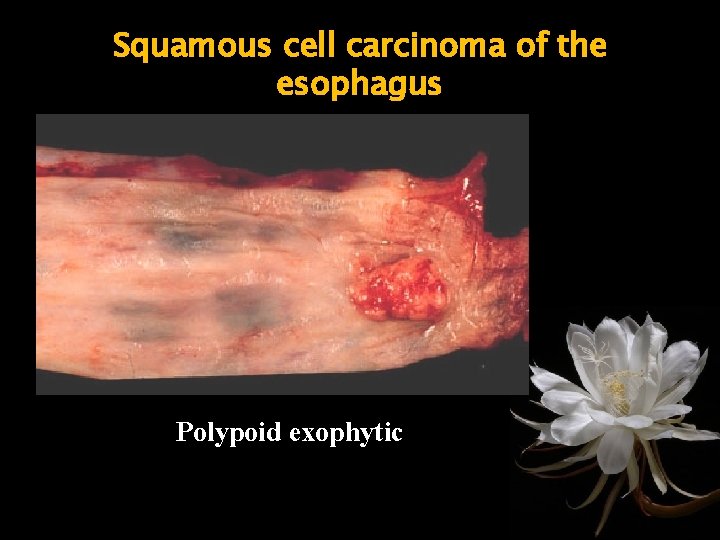 Squamous cell carcinoma of the esophagus Polypoid exophytic 