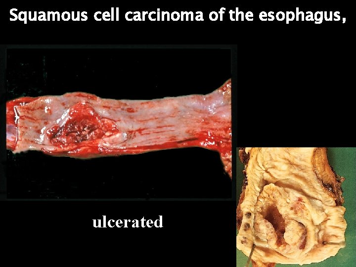 Squamous cell carcinoma of the esophagus, ulcerated 