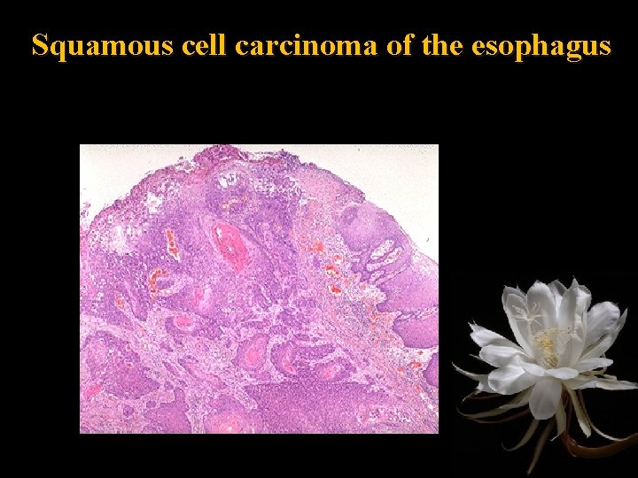 Squamous cell carcinoma of the esophagus 