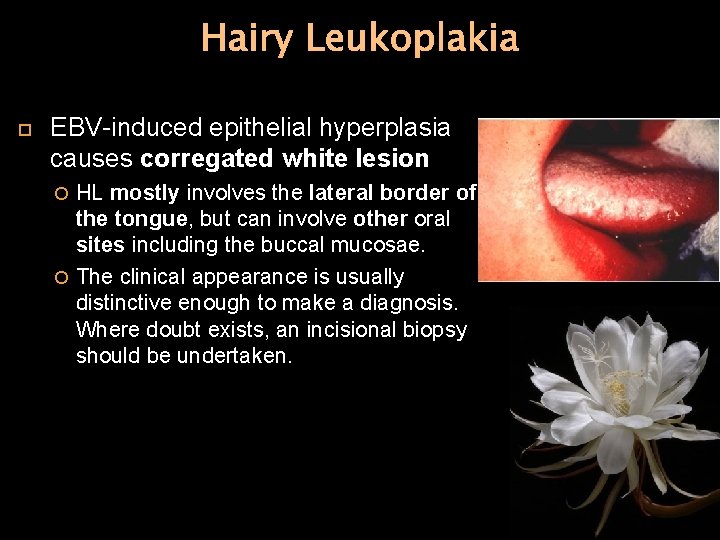 Hairy Leukoplakia EBV-induced epithelial hyperplasia causes corregated white lesion HL mostly involves the lateral