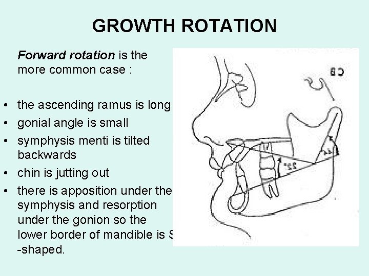 GROWTH ROTATION Forward rotation is the more common case : • the ascending ramus