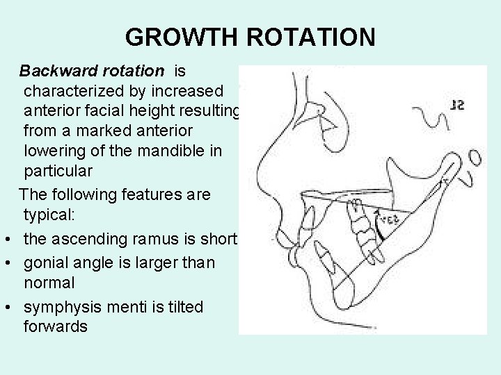 GROWTH ROTATION Backward rotation is characterized by increased anterior facial height resulting from a