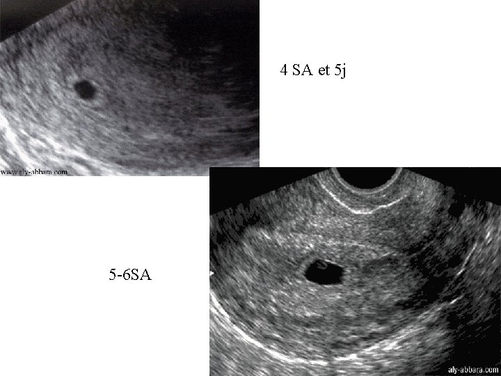 4 SA et 5 j 5 -6 SA 
