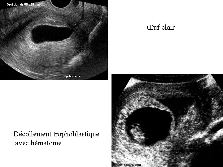 Œuf clair Décollement trophoblastique avec hématome 
