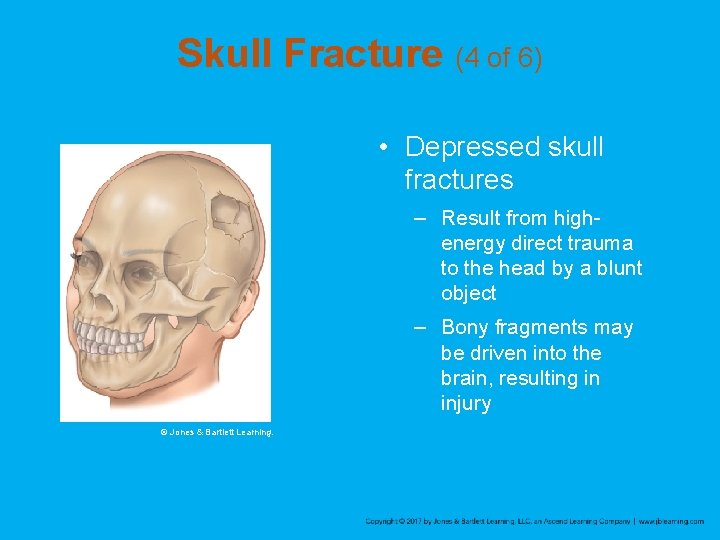 Skull Fracture (4 of 6) • Depressed skull fractures – Result from highenergy direct