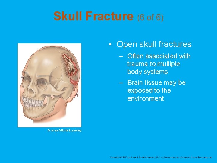 Skull Fracture (6 of 6) • Open skull fractures – Often associated with trauma