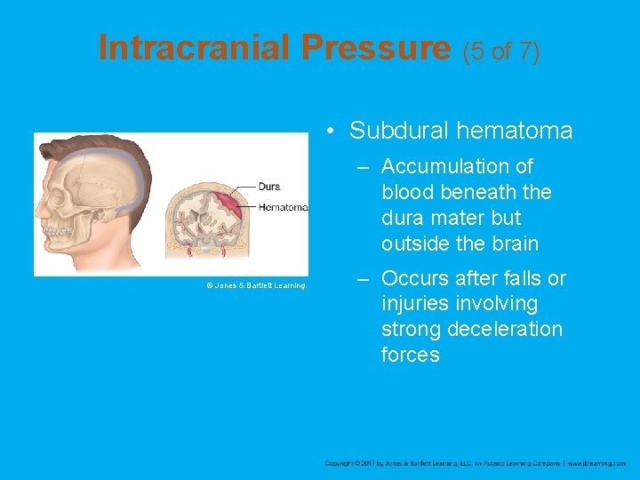 Intracranial Pressure (5 of 7) • Subdural hematoma – Accumulation of blood beneath the