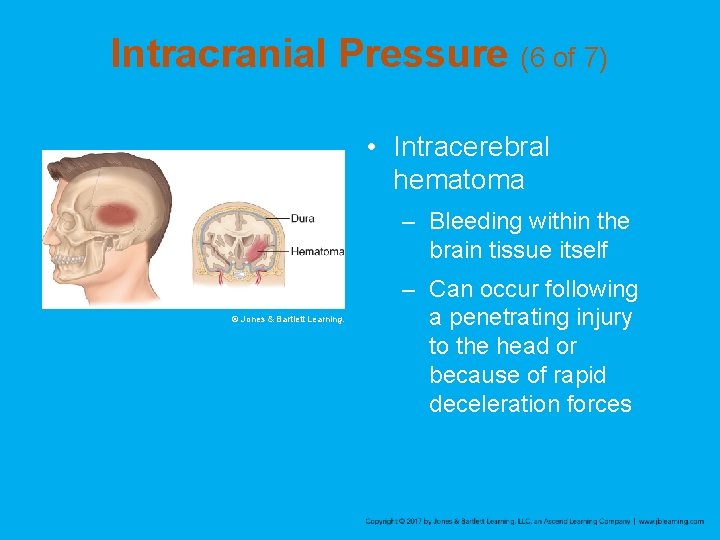 Intracranial Pressure (6 of 7) • Intracerebral hematoma – Bleeding within the brain tissue