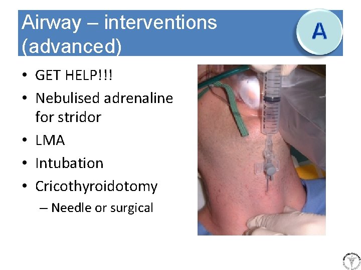 Airway – interventions (advanced) • GET HELP!!! • Nebulised adrenaline for stridor • LMA