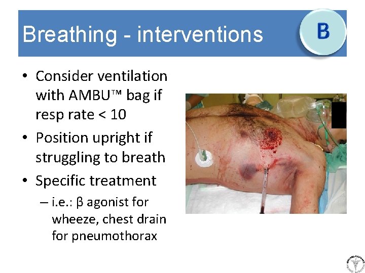 Breathing - interventions • Consider ventilation with AMBU™ bag if resp rate < 10