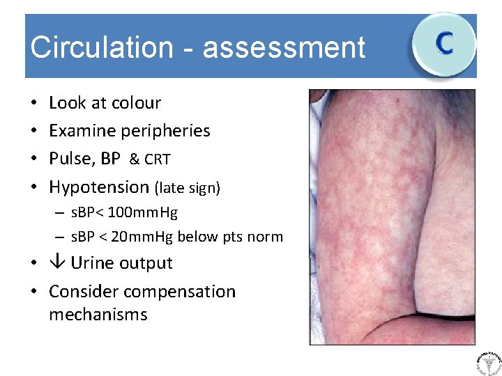 Circulation - assessment • • Look at colour Examine peripheries Pulse, BP & CRT