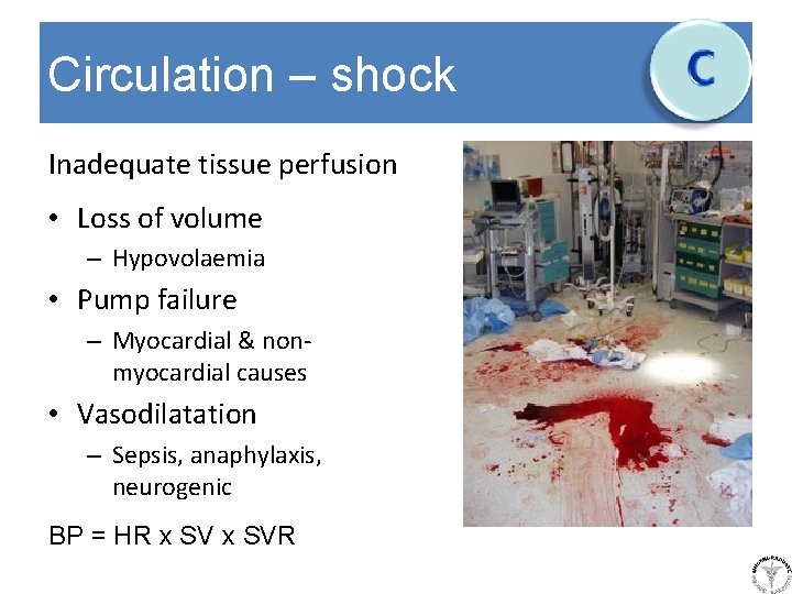 Circulation – shock Inadequate tissue perfusion • Loss of volume – Hypovolaemia • Pump