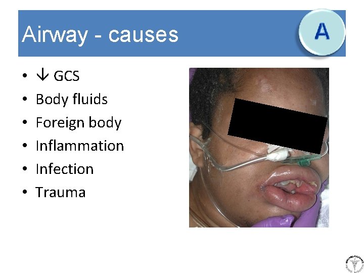 Airway - causes • • • GCS Body fluids Foreign body Inflammation Infection Trauma