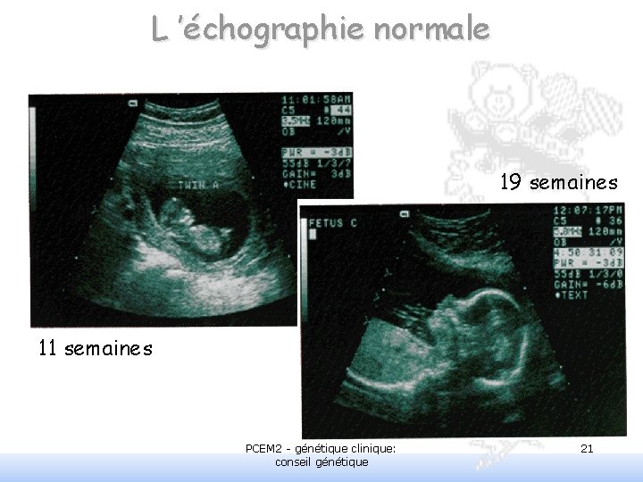 L ’échographie normale 19 semaines 11 semaines PCEM 2 - génétique clinique: conseil génétique