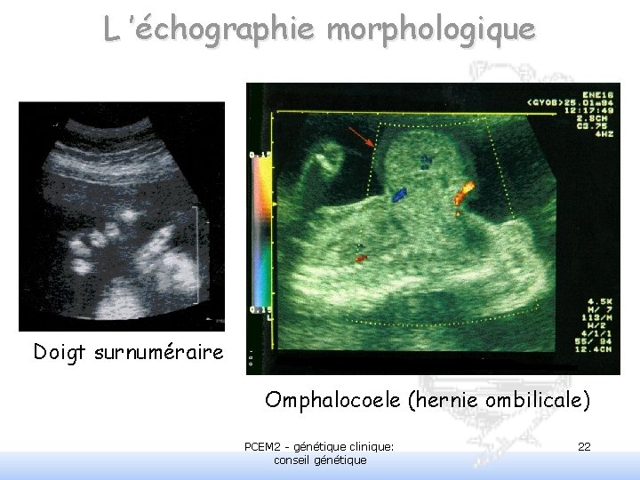 L ’échographie morphologique Doigt surnuméraire Omphalocoele (hernie ombilicale) PCEM 2 - génétique clinique: conseil