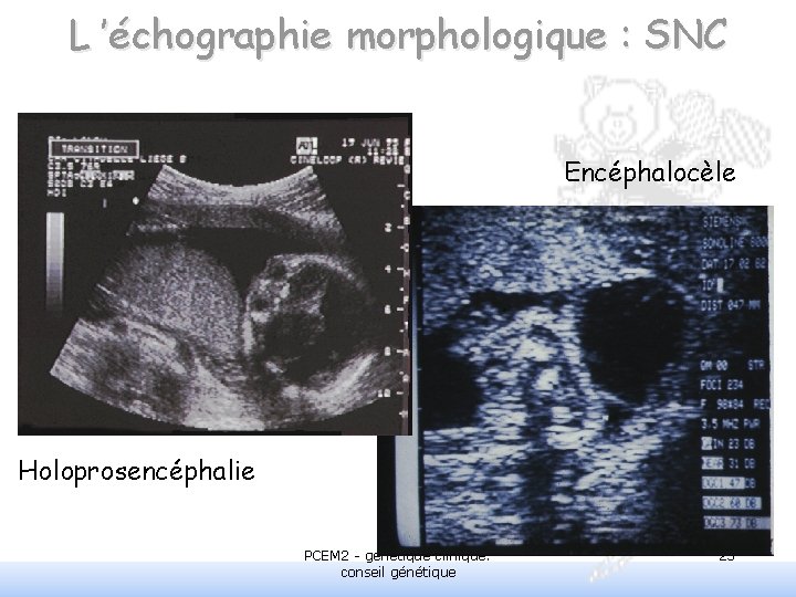 L ’échographie morphologique : SNC Encéphalocèle Holoprosencéphalie PCEM 2 - génétique clinique: conseil génétique