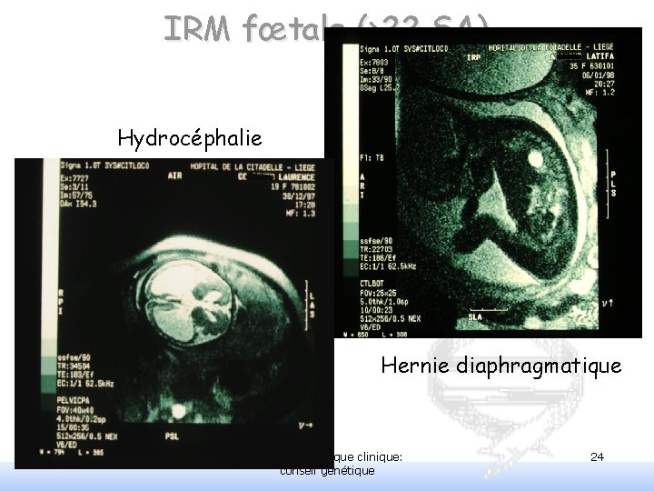 IRM fœtale (>22 SA) Hydrocéphalie Hernie diaphragmatique PCEM 2 - génétique clinique: conseil génétique