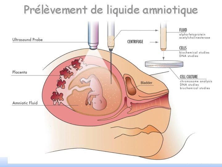 Prélèvement de liquide amniotique PCEM 2 - génétique clinique: conseil génétique 26 