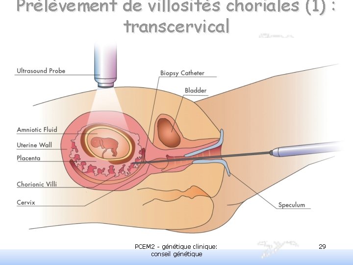 Prélèvement de villosités choriales (1) : transcervical PCEM 2 - génétique clinique: conseil génétique