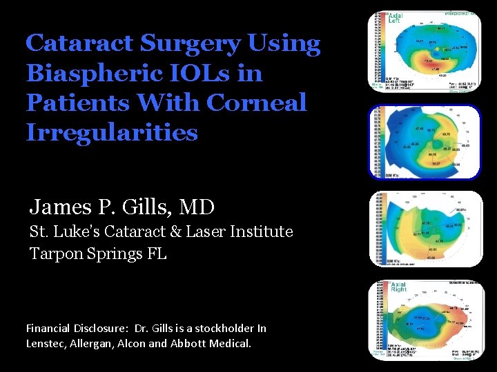 Cataract Surgery Using Biaspheric IOLs in Patients With Corneal Irregularities James P. Gills, MD