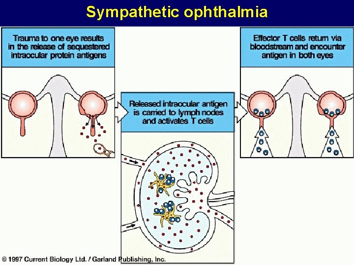 Sympathetic ophthalmia Sympathetic ophthalmia