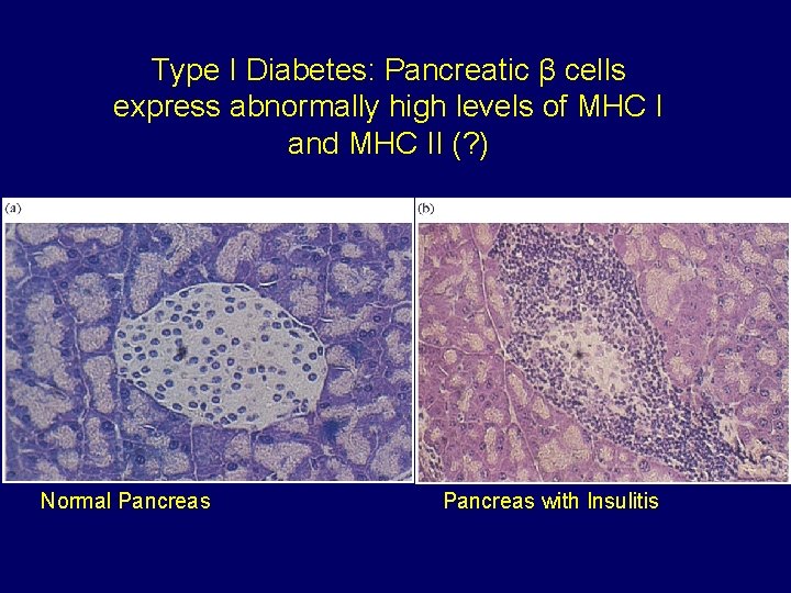 Type I Diabetes: Pancreatic β cells express abnormally high levels of MHC I and Type I Diabetes: Pancreatic β cells express abnormally high levels of MHC I and