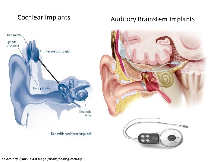 Cochlear Implants Source: http: //www. nidcd. nih. gov/health/hearing/coch. asp Auditory Brainstem Implants Cochlear Implants Source: http: //www. nidcd. nih. gov/health/hearing/coch. asp Auditory Brainstem Implants