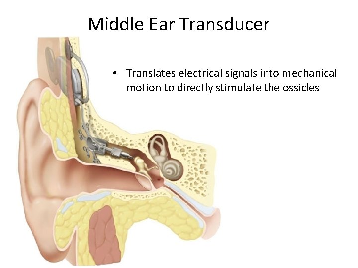 Middle Ear Transducer • Translates electrical signals into mechanical motion to directly stimulate the Middle Ear Transducer • Translates electrical signals into mechanical motion to directly stimulate the