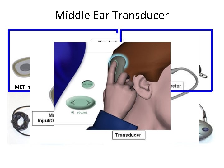 Middle Ear Transducer Remote MET Implant Charger Middle Ear Transducer Remote MET Implant Charger