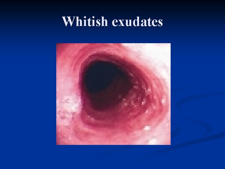 Whitish exudates 