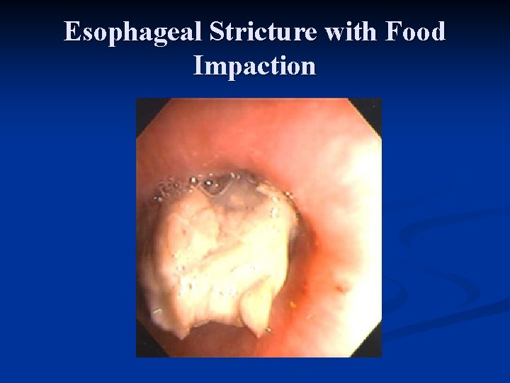 Esophageal Stricture with Food Impaction 