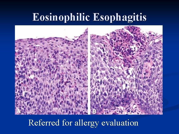 Eosinophilic Esophagitis Referred for allergy evaluation 