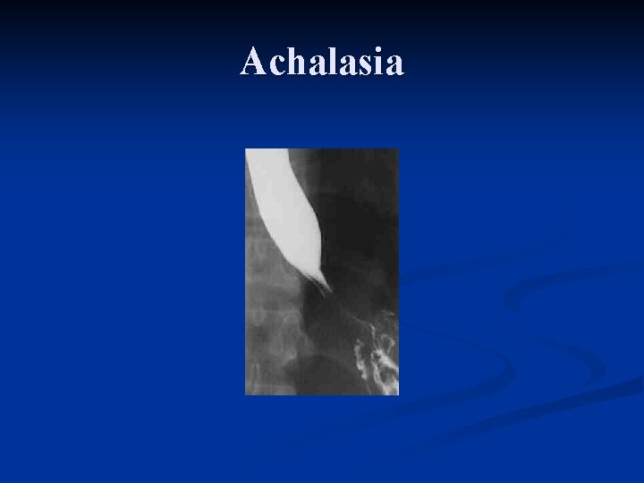 Achalasia 