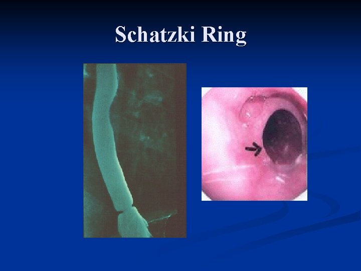 Schatzki Ring 