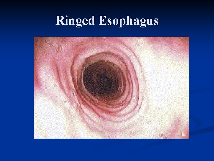Ringed Esophagus 