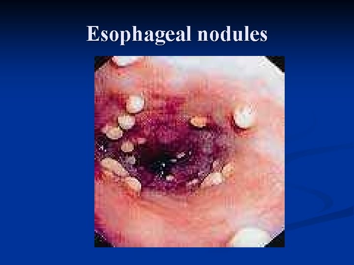 Esophageal nodules 