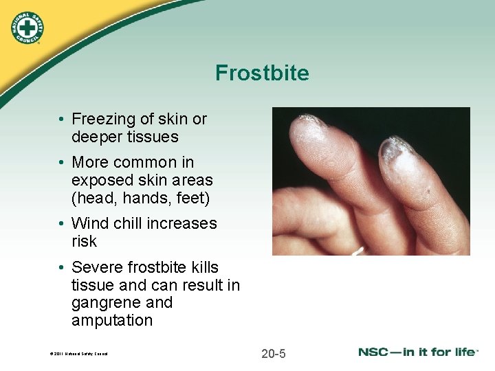 Frostbite • Freezing of skin or deeper tissues • More common in exposed skin