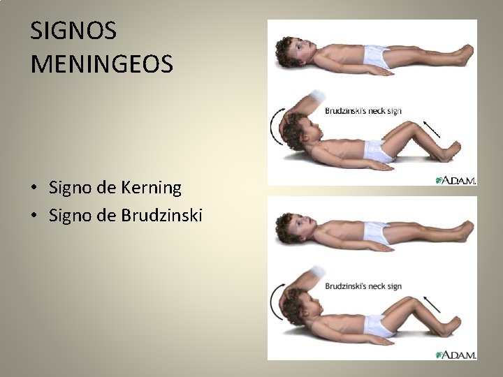 SIGNOS MENINGEOS • Signo de Kerning • Signo de Brudzinski 