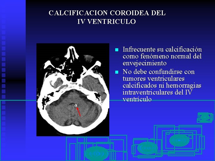 CALCIFICACION COROIDEA DEL IV VENTRICULO n n Infrecuente su calcificación como fenómeno normal del