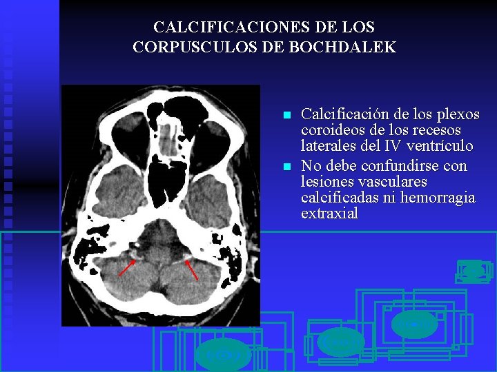 CALCIFICACIONES DE LOS CORPUSCULOS DE BOCHDALEK n n Calcificación de los plexos coroideos de