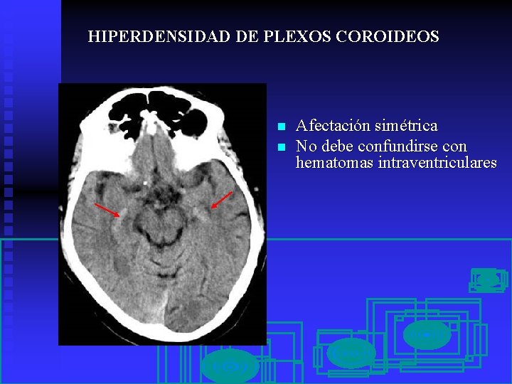 HIPERDENSIDAD DE PLEXOS COROIDEOS n n Afectación simétrica No debe confundirse con hematomas intraventriculares