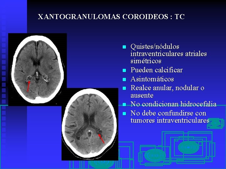 XANTOGRANULOMAS COROIDEOS : TC n n n Quistes/nódulos intraventriculares atriales simétricos Pueden calcificar Asintomáticos