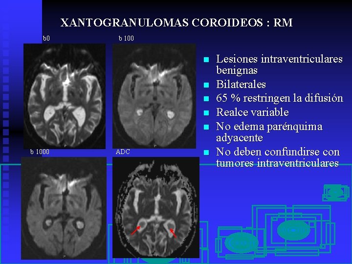 XANTOGRANULOMAS COROIDEOS : RM b 0 b 100 n n n b 1000 ADC