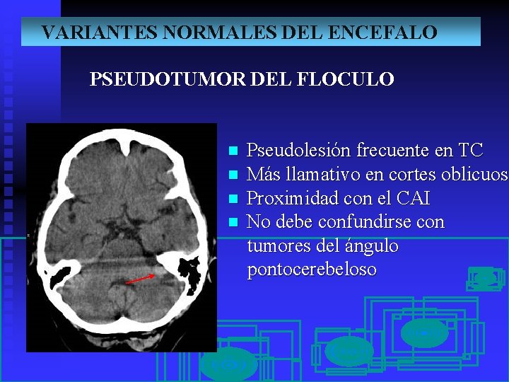 VARIANTES NORMALES DEL ENCEFALO PSEUDOTUMOR DEL FLOCULO n n Pseudolesión frecuente en TC Más