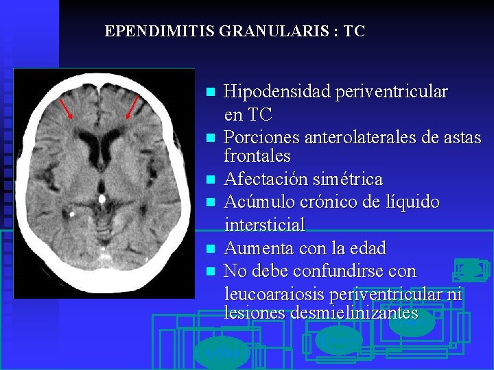 EPENDIMITIS GRANULARIS : TC n n n Hipodensidad periventricular en TC Porciones anterolaterales de