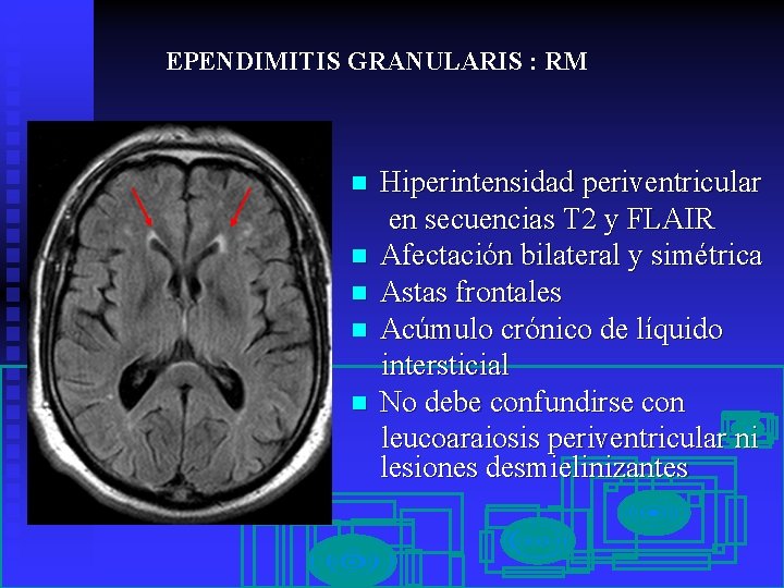 EPENDIMITIS GRANULARIS : RM n n n Hiperintensidad periventricular en secuencias T 2 y